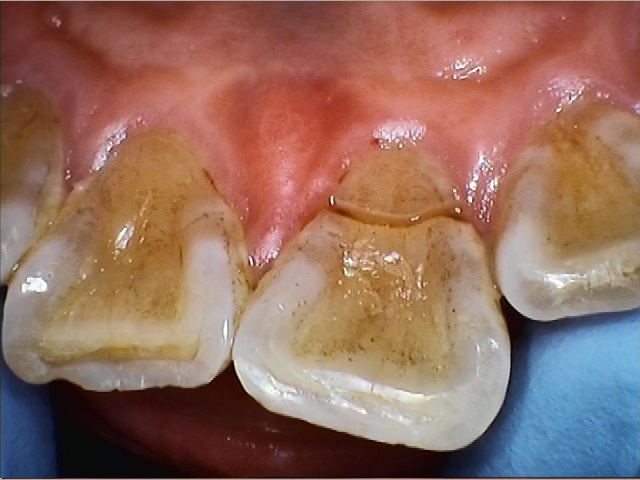 前歯のインプラント術前