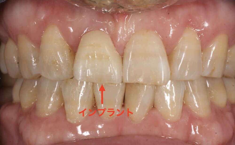 抜歯即時埋入インプラント