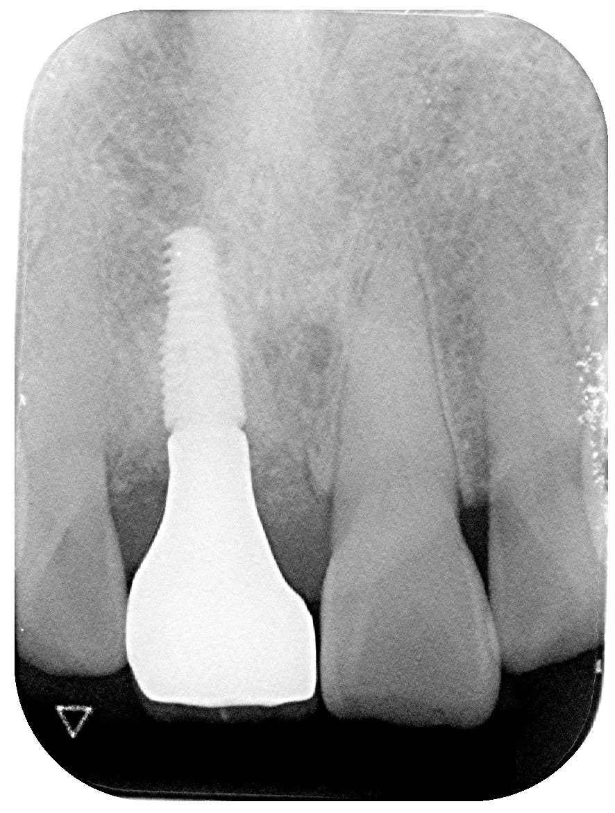抜歯即時埋入インプラント
