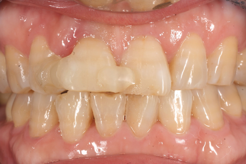 インプラント前歯