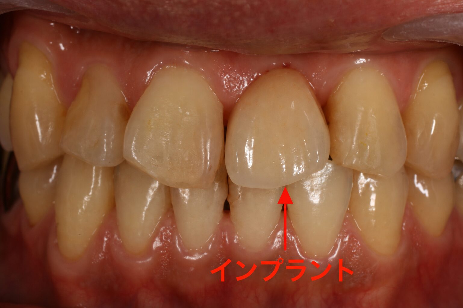 上の前歯のインプラント治療後の正面観口腔内写真