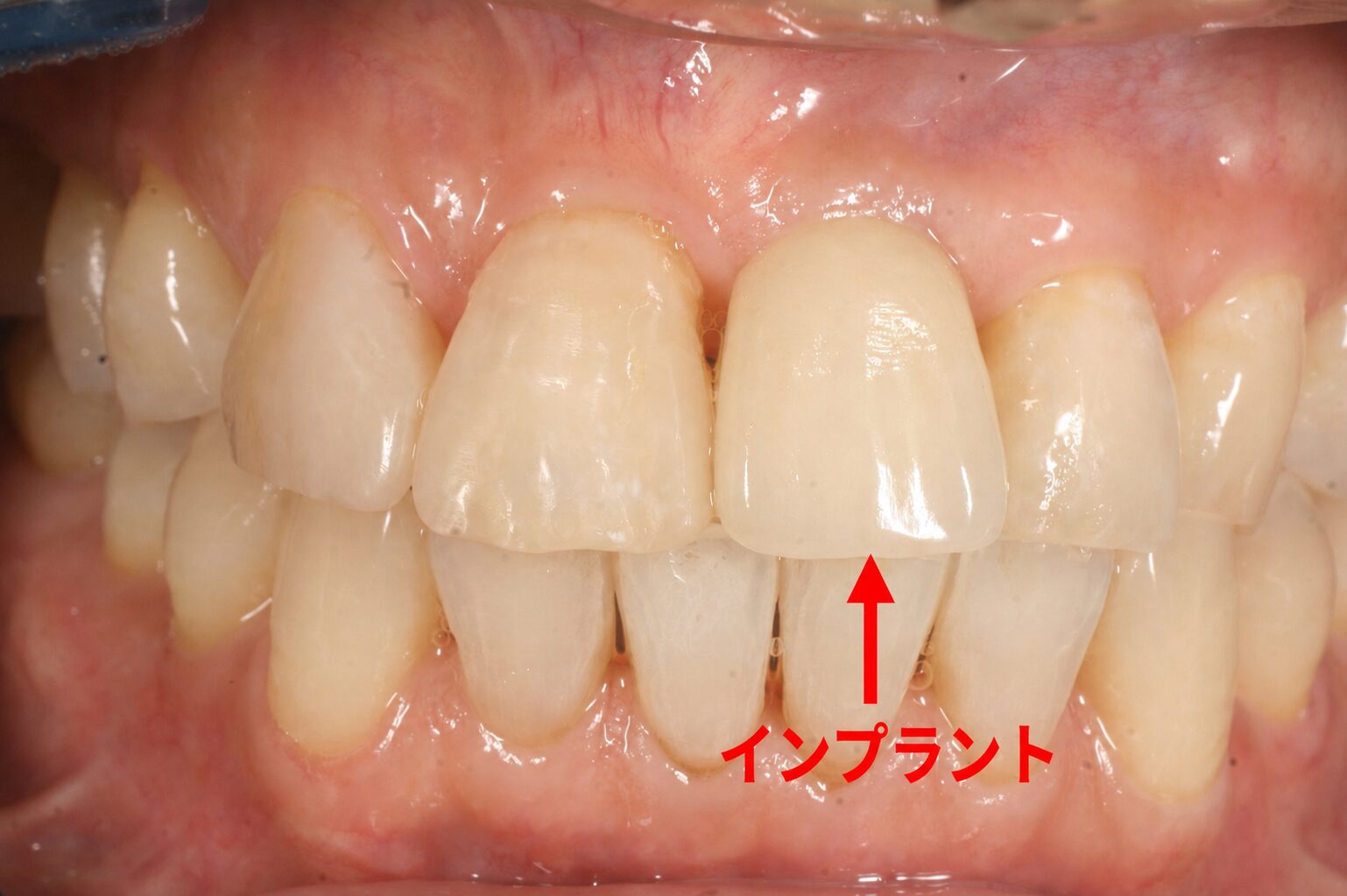 ぐらついていた前歯をインプラントで治療した終了時の状態