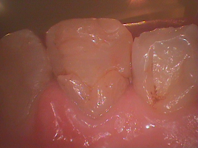横向きに折れた状態が認められた上の前歯の治療前口腔内写真