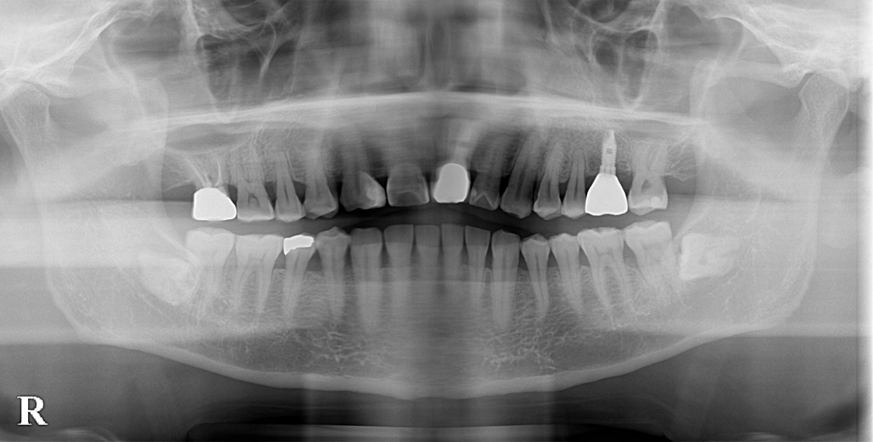 前歯のインプラント治療後にお口全体を確認したレントゲン写真