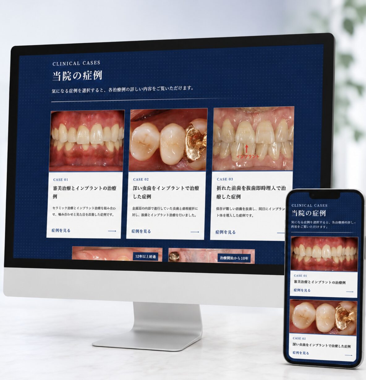 曽我歯科医院三軒茶屋のインプラント症例ページをパソコンとスマートフォンに表示したイメージ
