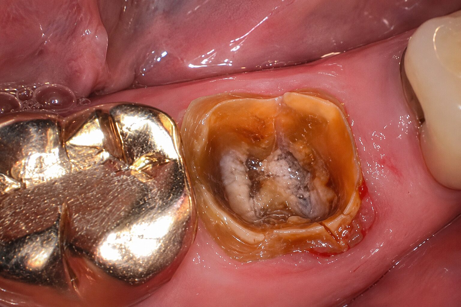 歯の根が割れていた右下の奥歯の治療前写真