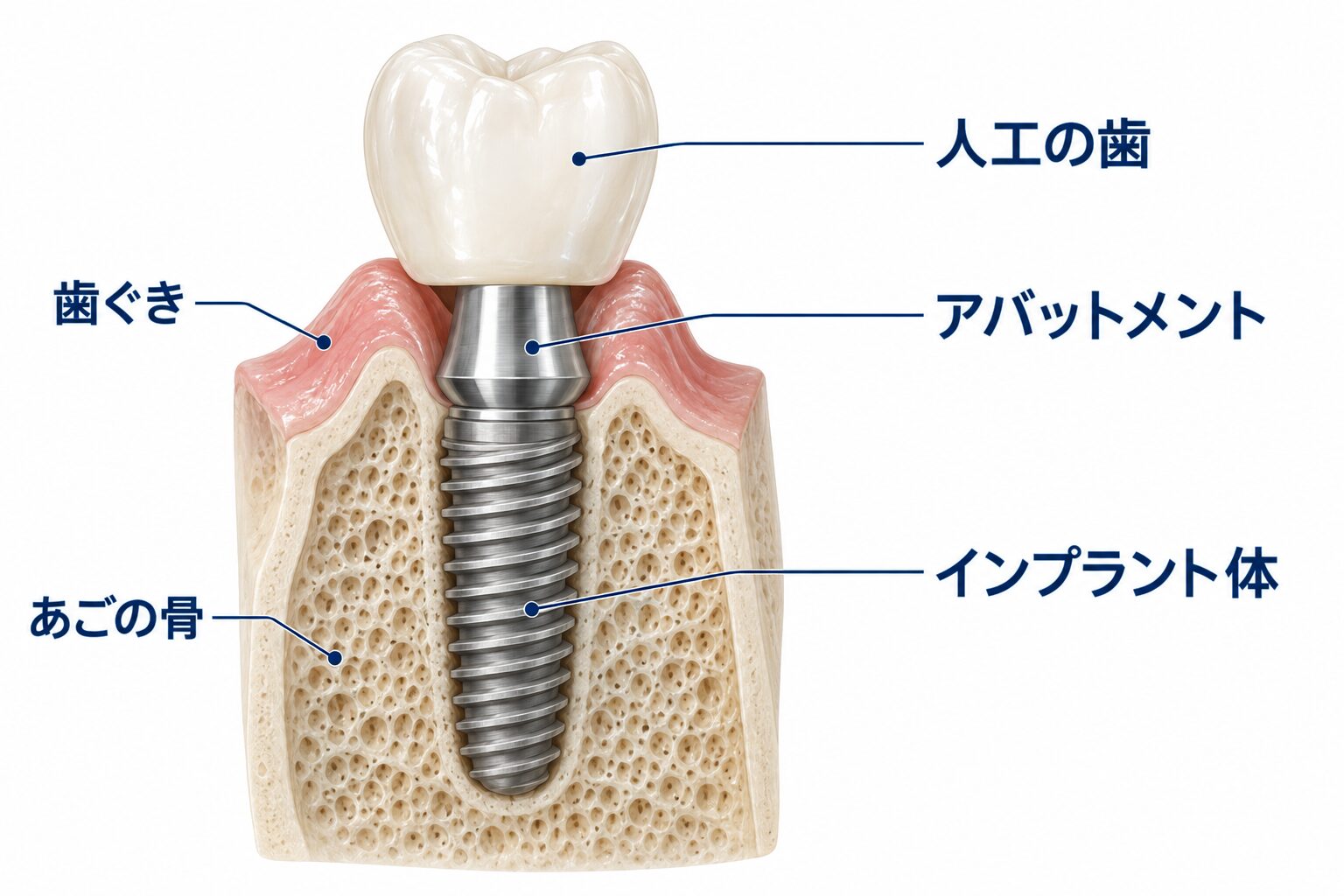 人工の歯、アバットメント、骨に埋まるインプラント体の関係を示した断面模式図