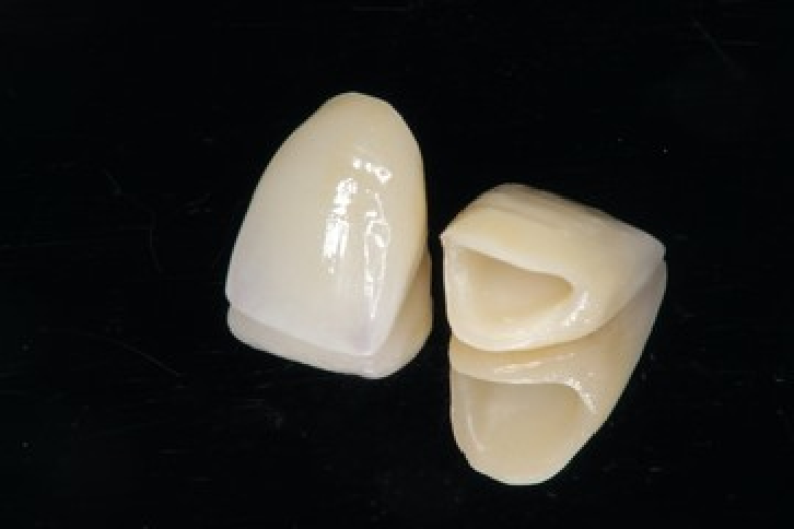 セラミック修復