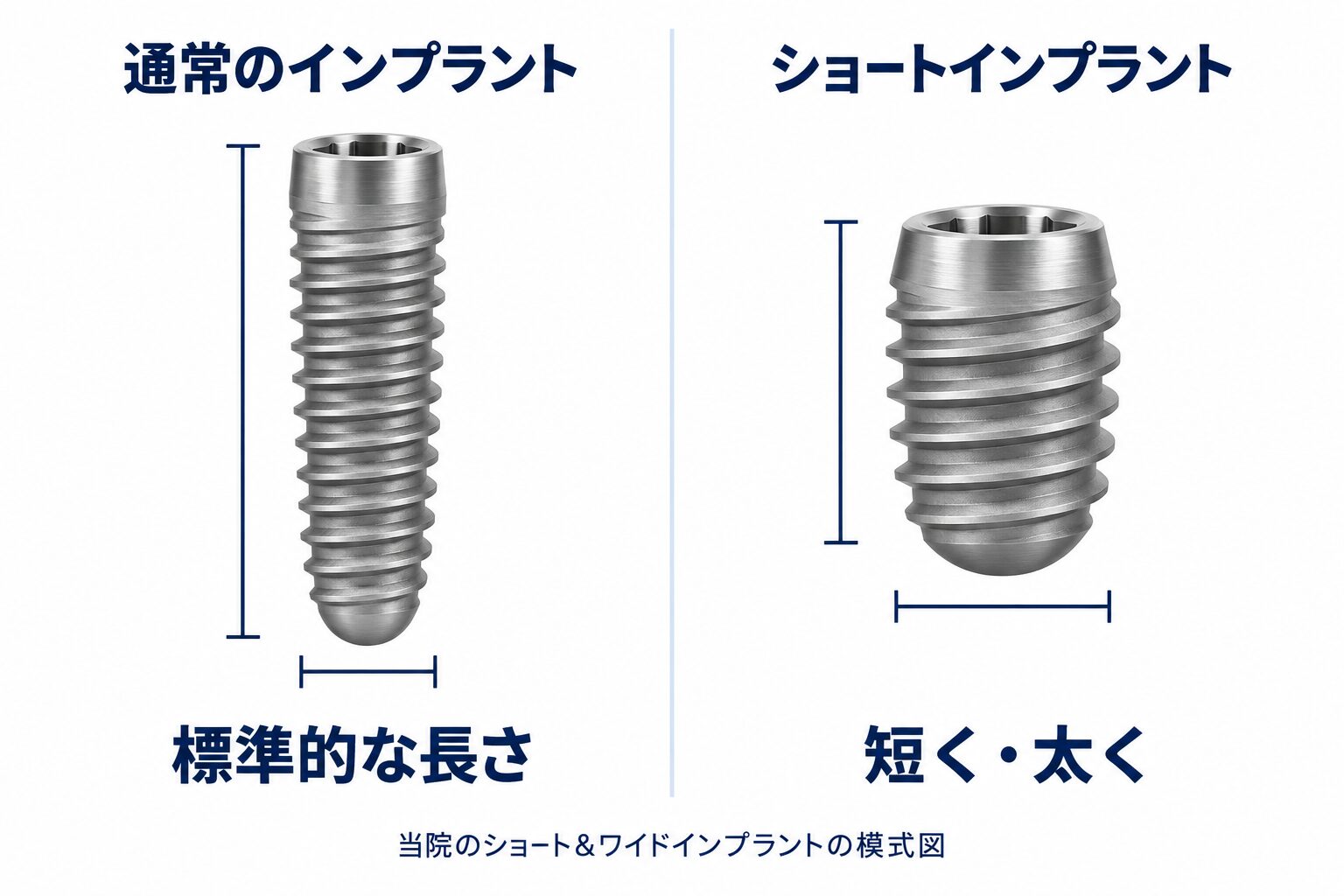 通常の長いインプラントと、当院で使用する短く太いショート＆ワイドインプラントの比較図