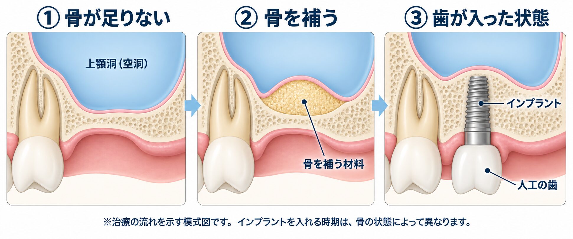 左から、骨の高さが足りない状態、空洞の膜の下に骨を補う材料を入れた状態、骨に支えられたインプラントと人工の歯が入った状態。