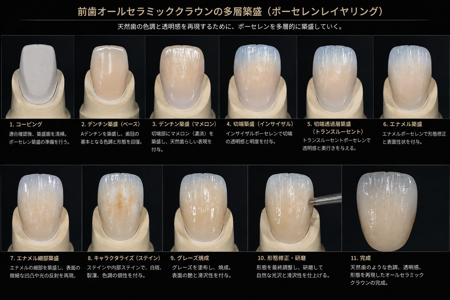 前歯セラミッククラウンのポーセレンレイヤリング